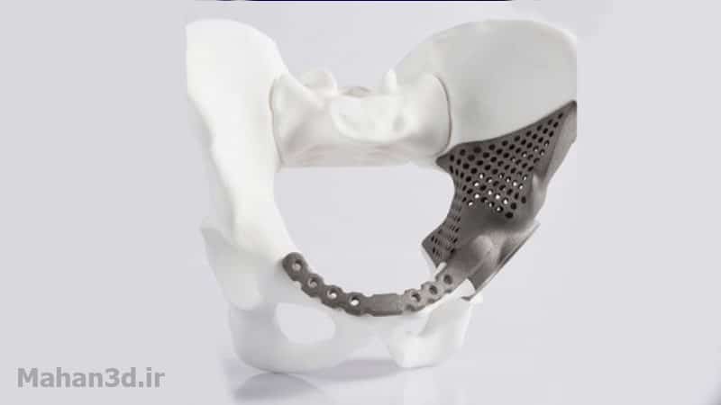 استفاده از پرینتر سه بعدی برای طراحی و ساخت ارتز سفارشی گردن